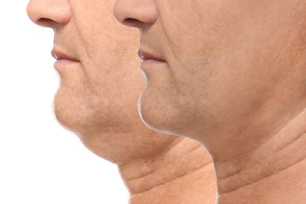 HIFU - Breakthrough in Anti - ageing 2 hifu results Ferndown