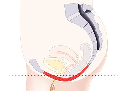 Pelvic-Floor Muscle Repair 5 Pelvic floor muscles Ferndown