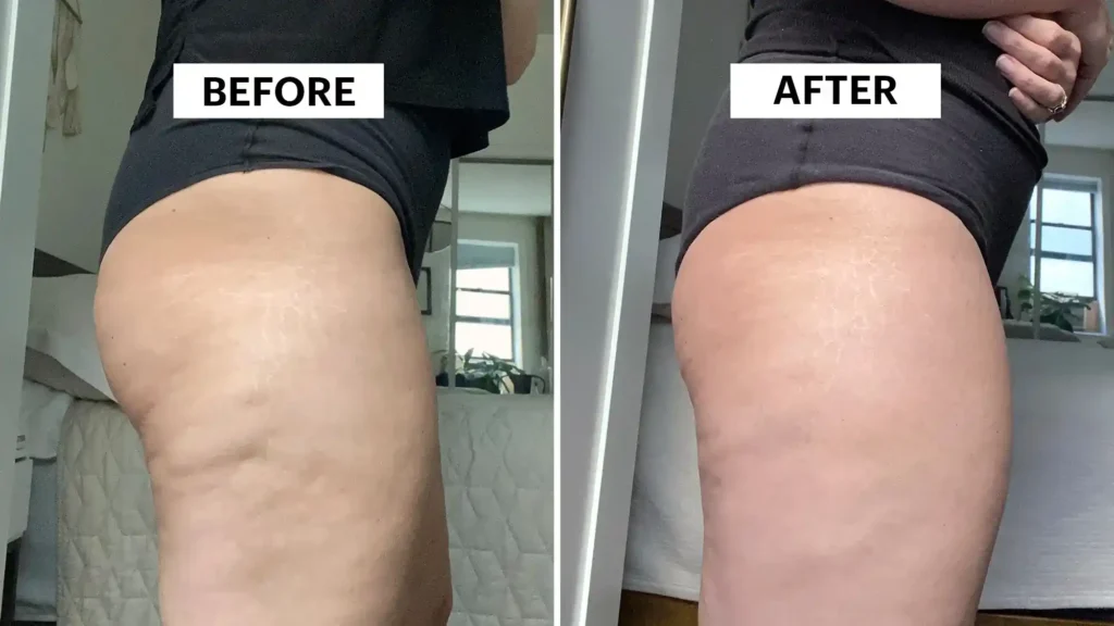 Sculpting Your Bum: Can Toning Exercises Really Reduce Cellulite? 1 Do Toning Exercise Ferndown Really Tackle Cellulite?