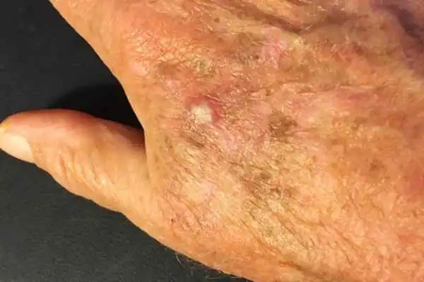 Image of Actinic keratoses Ferndown on a person hand